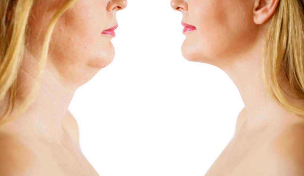 Double Chin treatment Sparkhill before and after results