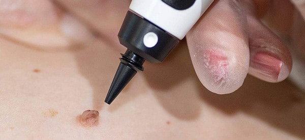 After Skin Tag Removal Sparkhill