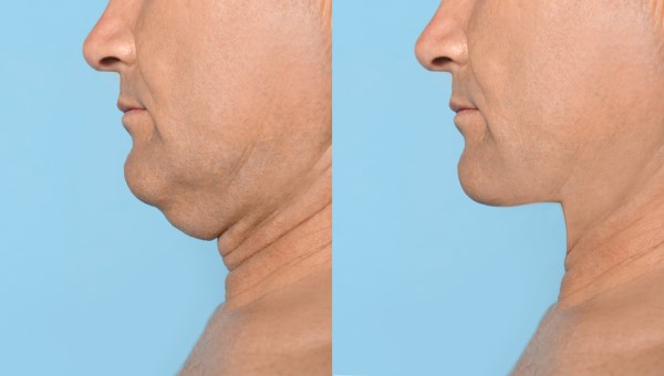 Which Non-Surgical Treatments Work Best for Jowls and Loose Skin Sparkhill?