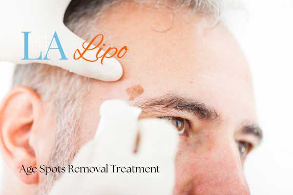 What Are the Most Effective Treatments for Age Spots Sparkhill?