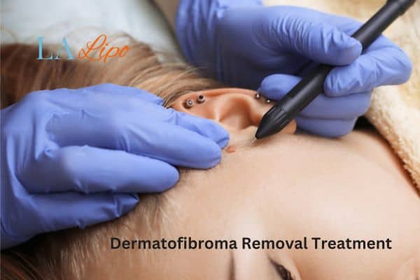 Dermatofibroma Removal Treatment Sparkhill