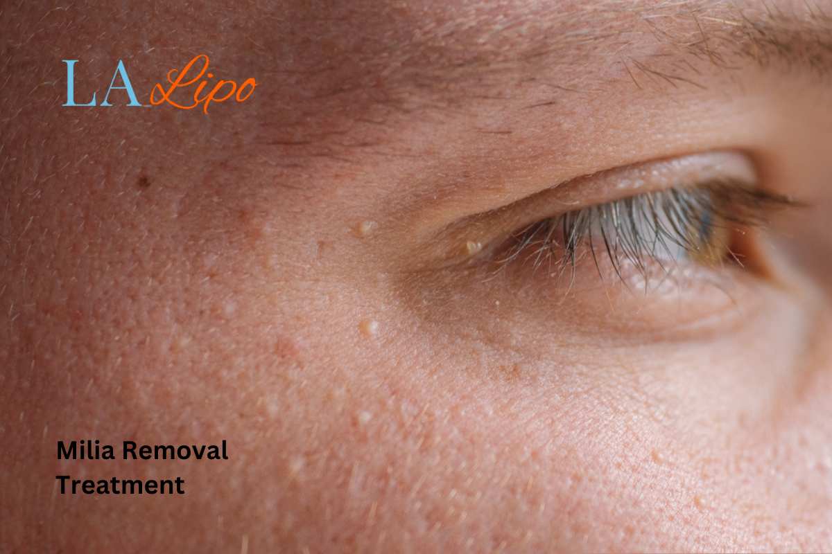 Cryopen Milia Removal: Is It the Easiest and Safest Option Sparkhill?