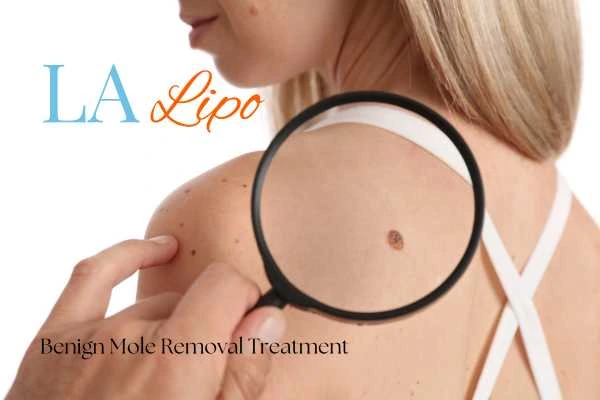 Woman having her inspection of blemish before mole removal Sparkhill
