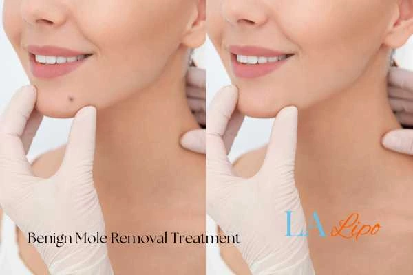 woman's before and after mole removal Sparkhill results