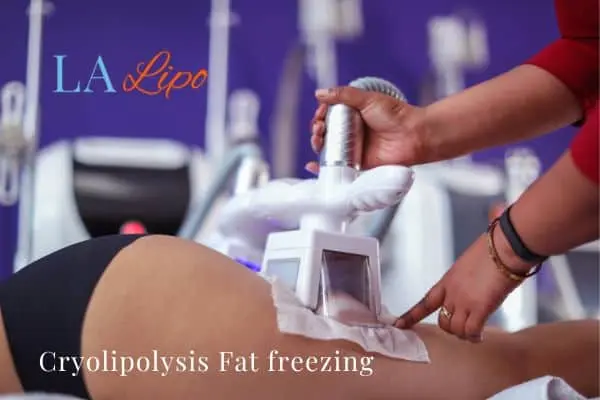 women getting fat freezing Sparkhill