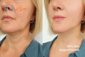 hi-fu for wrinkles Sparkhill before and after results