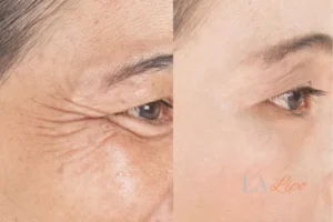 Before and after results of woman - HI-fu wrinkles reduction treatment Sparkhill