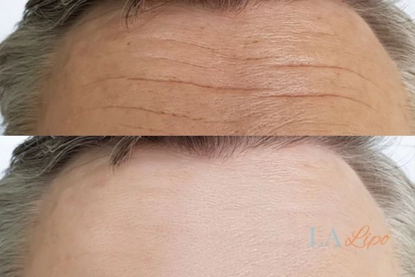 results of HIFU Sparkhill on mans forehead to help reduce lines and wrinkles