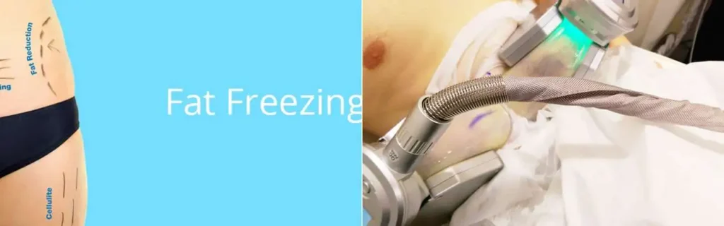 Fat freezing Sparkhill on multiple areas of the body
