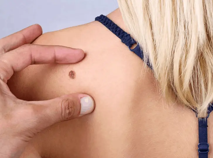 woman having mole removal Sparkhill consultation before treatment.