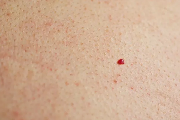 close up of a cherry angioma Sparkhill