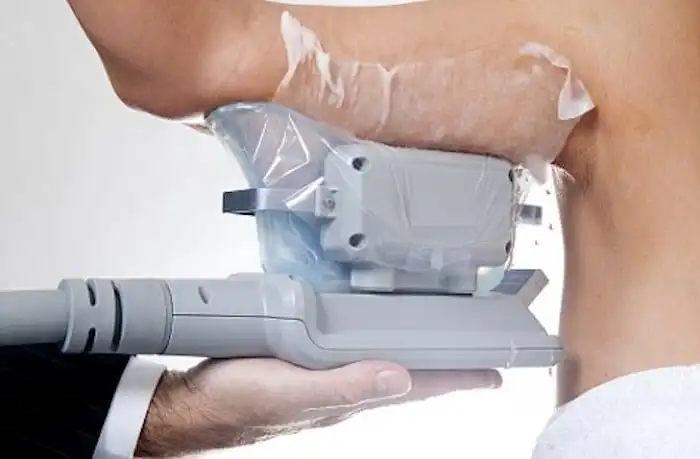 Picture of fat freezing Sparkhill on the upper arms.