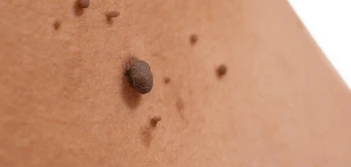 image of a skin tag Sparkhill