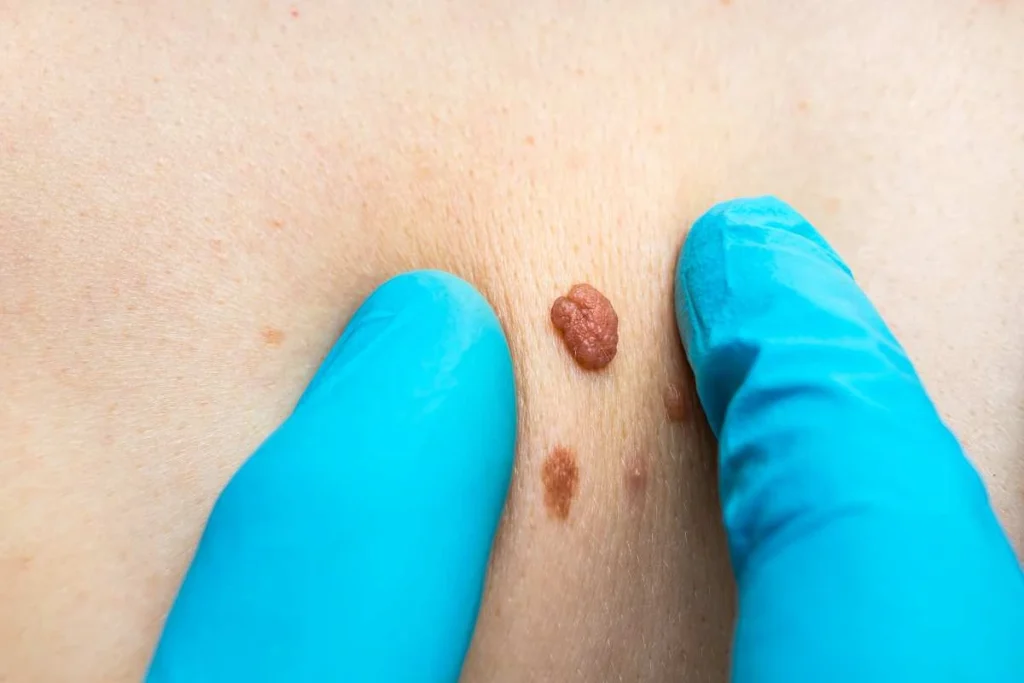 Consultant examining a skin tag Sparkhill