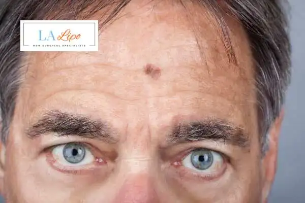 Solar Lentigo Removal Sparkhill image of man with mark on his forehead