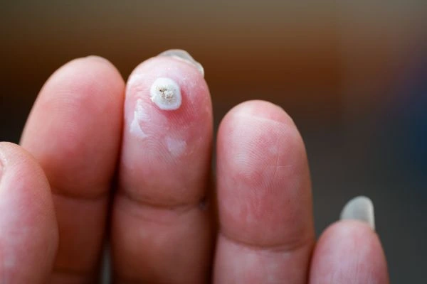 wart on person finger - cryotherapy to treat from LA LIPO Sparkhill