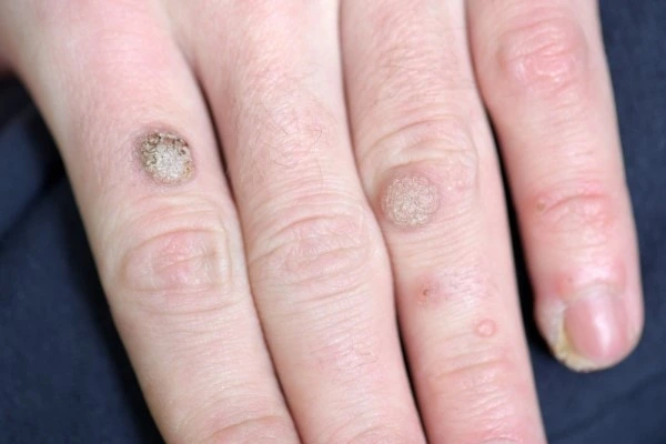 photo of warts on person hand - see wart removal Sparkhill from LA LIPO