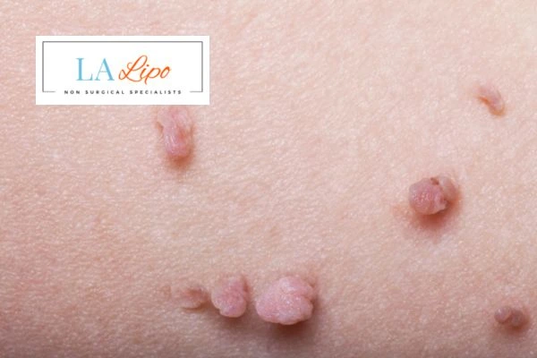 Does cryopen skin tag removal Sparkhill hurt? Find out now call our team today!