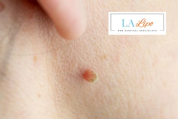 Book skin tag removal Sparkhill today speak to our team now!