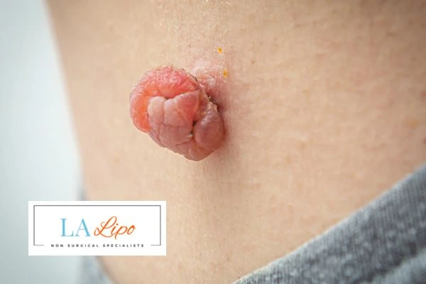 Interested in skin tag removal Sparkhill? Concerned about the pain? Find out more today!