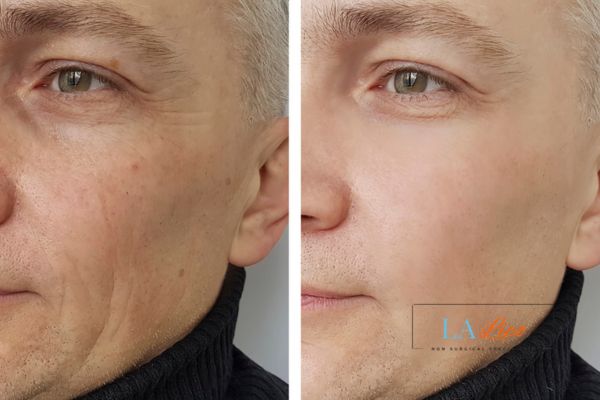 See the amazing results of Morpheus8 Treatment Sparkhill!