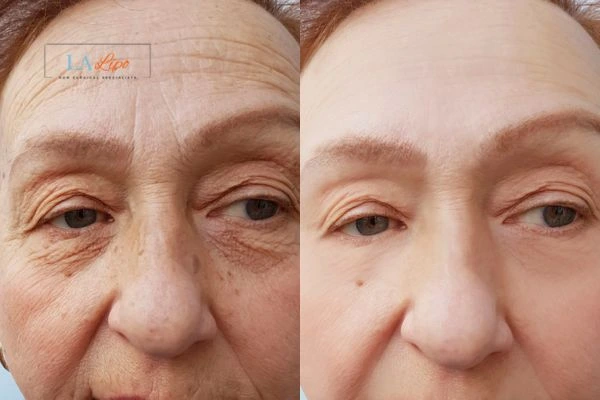 The powerful benefits of Morpheus8 Treatment Sparkhill - Call Our team today!