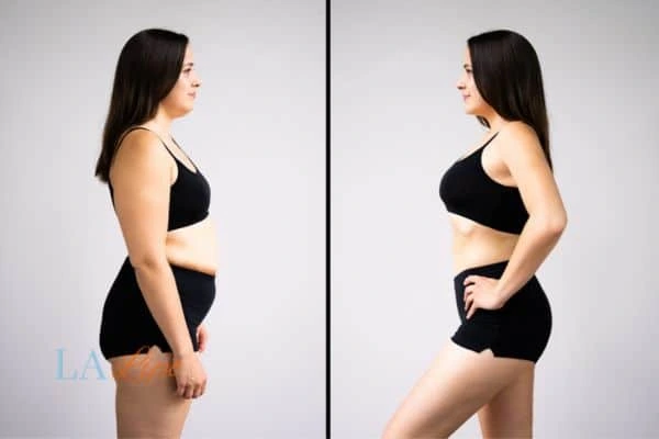 Picture of womans before and after using LA-EMS body sculpting to improve her core strength Sparkhill