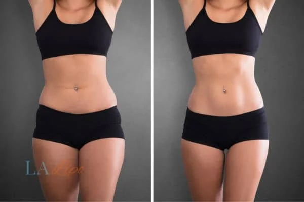 before and after results of non-surgical treatment to help a woman's body image and mental health Sparkhill