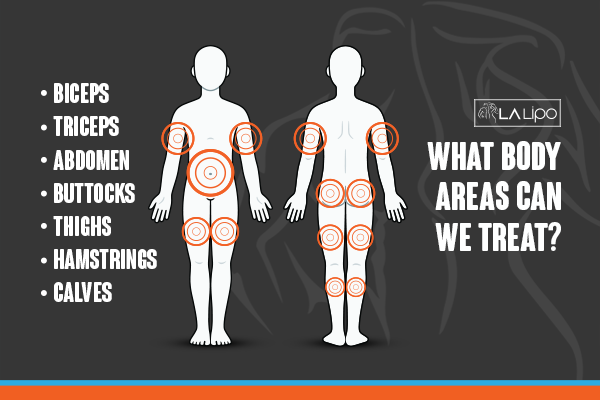 Diagram to show areas you can have LA-EMS Body Sculpting Treatment Sparkhill