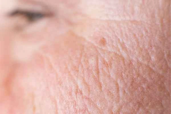 close up picture of a woman's face showing an age spot Sparkhill