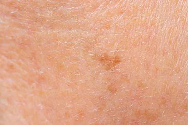 close up picture of age spots Sparkhill