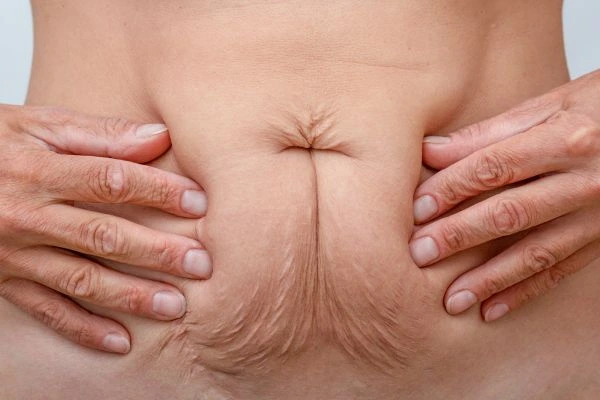 Should I Combine Diastasis Recti Treatment with Body Contouring for Better Results Sparkhill?