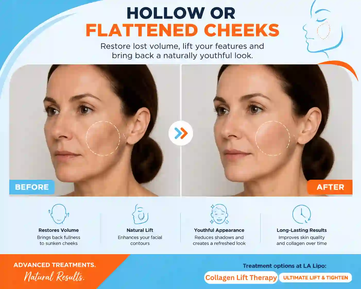 Sign #4: Hollow or Flattened Cheeks Sparkhill