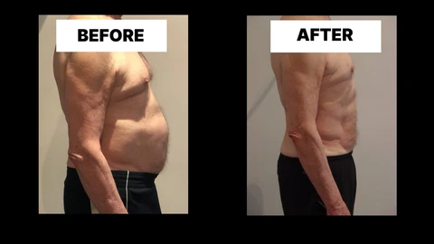 What Symptoms Can Diastasis Recti Cause in Men? Weak Core, Back Pain and Poor Posture Sparkhill